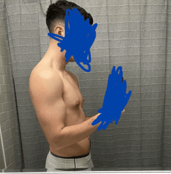 Heavier chest with mixed glandular and fatty fullness.
