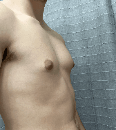 Lean teenage chest with a tender glandular bud under one nipple.