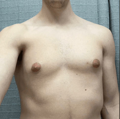 Long-standing grade-4 chest with significant volume and laxity.