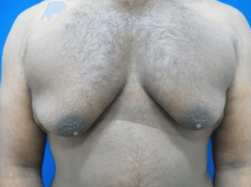 Heavier chest, largely fatty, before a major weight-loss effort.