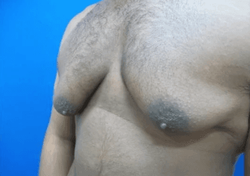 Much leaner chest after fifty pounds lost, minor residual fullness.