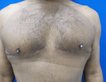Post-op chest, twelve months out, flat profile.