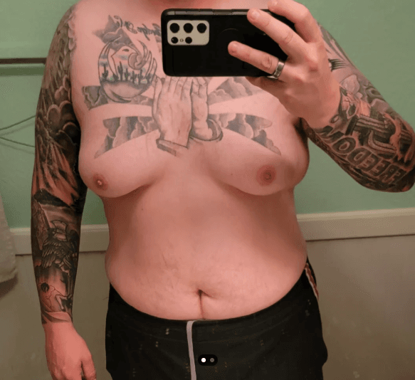 Pre-op chest with pronounced glandular tissue and surrounding fat.