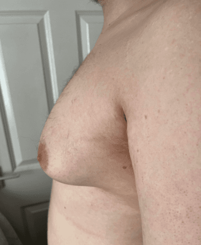 Pre-op chest in profile, lean build, firm glandular tissue under the nipple.