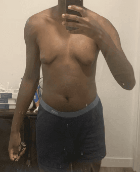 Lean young chest with a small symmetric glandular bud under each nipple.