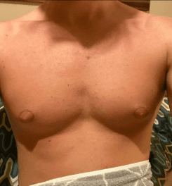 Leaner, more defined chest a year on.