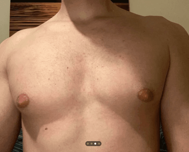 Lean athletic chest with mild residual fullness under the nipples.