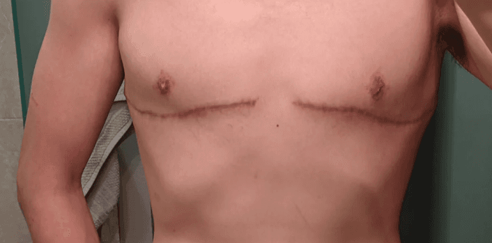 Flat chest with healed horizontal scar lines, fully recovered.