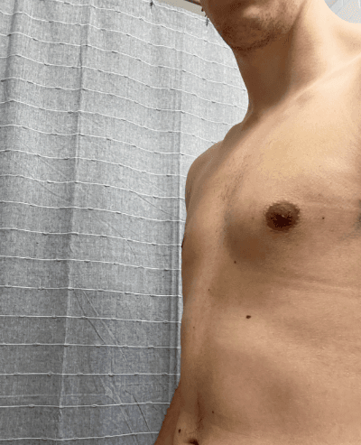 Chest with stable, long-standing mild glandular fullness.