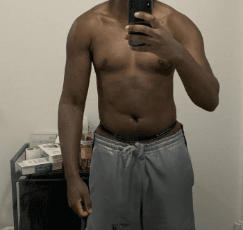 Chest at onset, mildly enlarged.